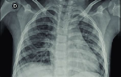 Radiografía de tórax mostrando dextrocardia e infiltrados pulmonares, signos típicos en pacientes con SK.