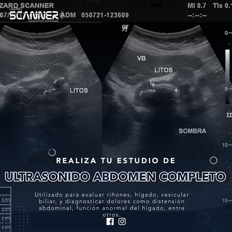 Esquema de un ultrasonido en un abdomen de una embarazada