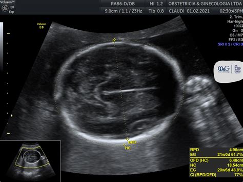 Ecografía fetal mostrando el fémur
