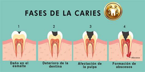 Infografía detallando las etapas de desarrollo de la caries dental en dientes de leche.