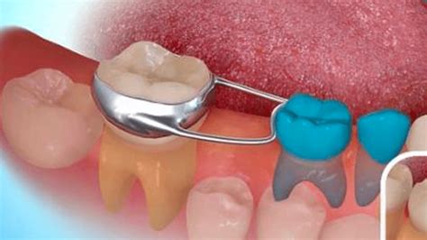 Imagen de un mantenedor de espacio dental infantil.