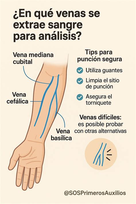 Ilustración de una extracción de sangre venosa del brazo para una prueba médica