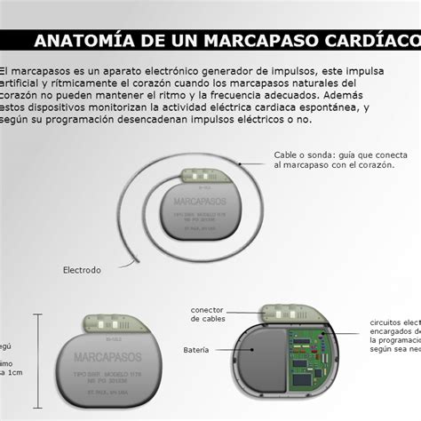 Diagrama de un marcapasos artificial con sus componentes (generador y electrodos)