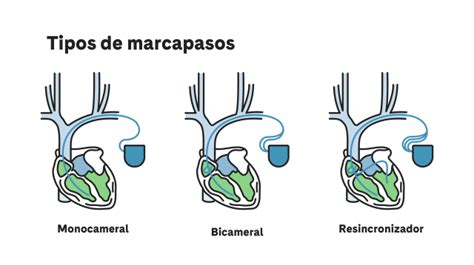 Infografía comparativa de diferentes tipos de marcapasos