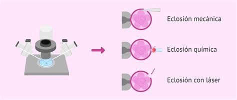 Diagrama mostrando las diferentes técnicas de eclosión asistida (láser, química, mecánica)