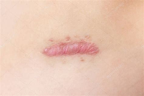 Foto: Primer plano de una cicatriz queloide en piel