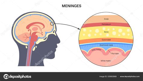 Esquema de las meninges y el cerebro con zonas de inflamación