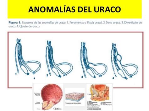 Diagrama anatómico del uraco y sus posibles anomalías (uracosinus, quiste, fístula)