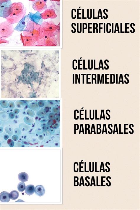 ilustración: tipos de células epiteliales vaginales (parabasales, intermedias, superficiales)
