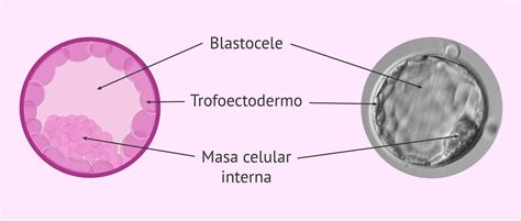 Ilustración de un blastocisto con la masa celular interna (MCI) y el trofoectodermo