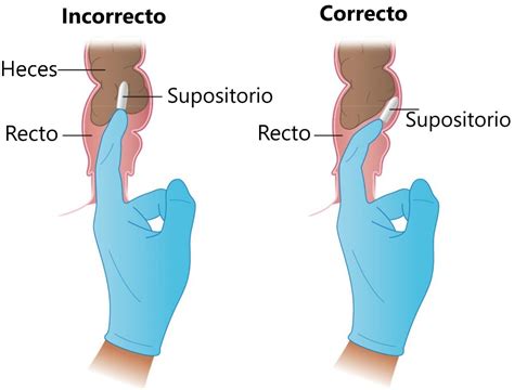 Infografía mostrando la correcta administración de un supositorio rectal en un bebé