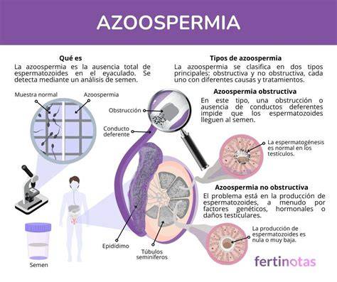 Diagrama: Diferencia visual entre azoospermia obstructiva y secretora