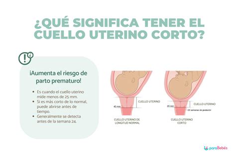 Esquema de un útero con cuello uterino corto y placenta