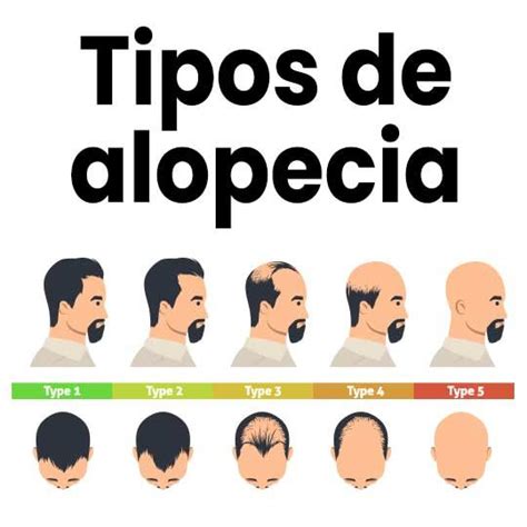 Diagrama de los diferentes tipos de alopecia en la infancia y sus características