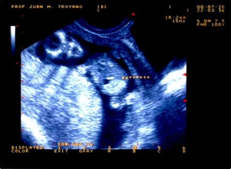 Ecografía fetal mostrando intestino hiperecogénico