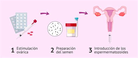 Esquema de la inseminación artificial mostrando la introducción de espermatozoides en el útero