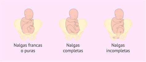 Ilustración de los diferentes tipos de presentación de nalgas