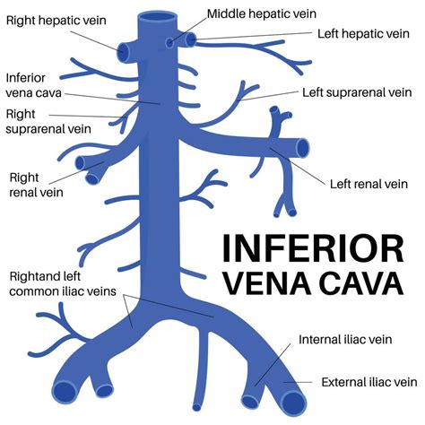 Ilustración de la vena cava y el útero en crecimiento comprimiéndola al acostarse boca arriba.