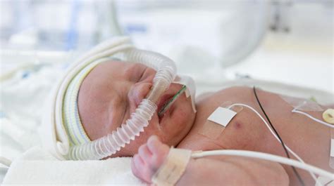Fotografía de un bebé prematuro con dificultad respiratoria