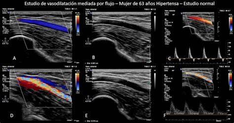 Imagen de un ecógrafo Doppler mostrando el flujo sanguíneo con colores