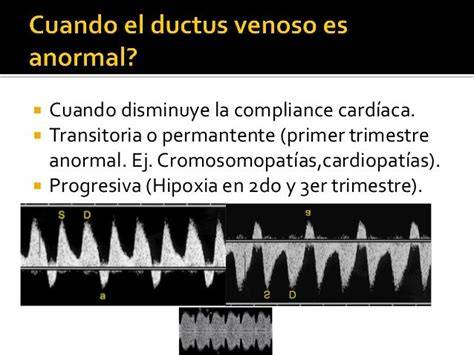 Diagrama de las técnicas sagital y transversal para la medición del Doppler del ductus venoso