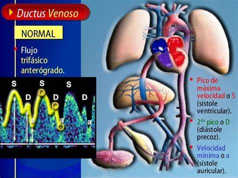 Gráfico de una onda de velocidad de flujo normal y anormal del ductus venoso