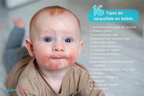 Infografía: Tipos de sarpullidos comunes en bebés con ilustraciones
