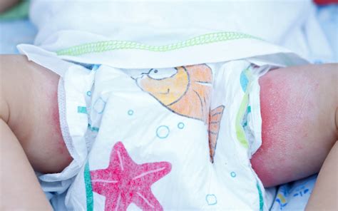 Foto: Bebé con dermatitis del pañal recibiendo un cambio de pañal con cuidado