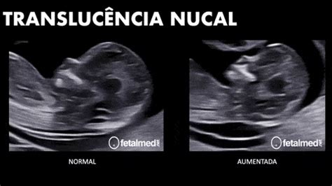 Ecografía fetal mostrando la translucencia nucal