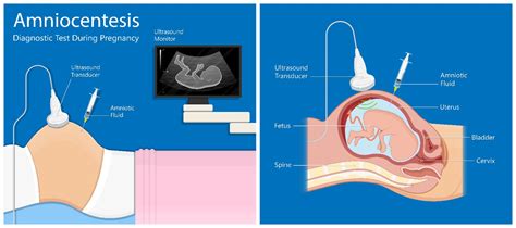 Ilustración del procedimiento de amniocentesis