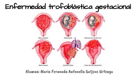 Ilustración esquemática de las diferentes formas de enfermedad trofoblástica del embarazo