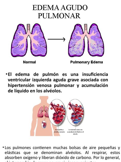 Esquema de un pulmón con edema pulmonar, mostrando la acumulación de líquido en los alvéolos.