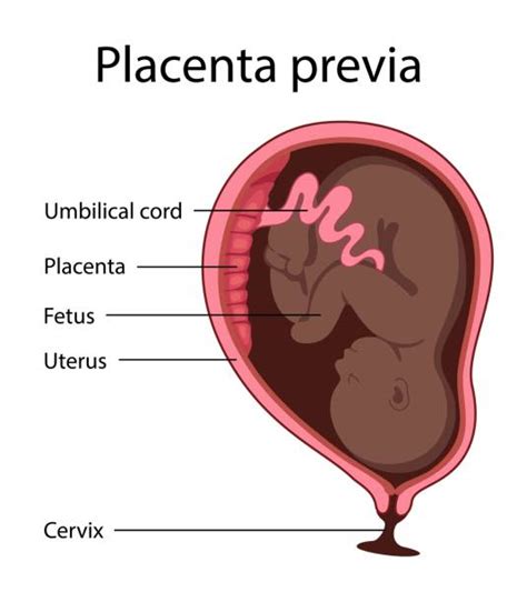 Ilustración médica que muestra la placenta separándose de la pared uterina antes del nacimiento del bebé.