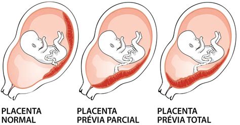 Infografía comparando una placenta en posición normal y una placenta previa.