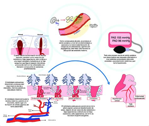 Esquema de la patogenia de la preeclampsia y progresión a eclampsia