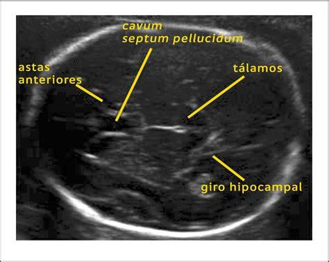 Esquema de un corte axial de la cabeza fetal donde se señalan la línea media, el cavum y los puntos de medición del diámetro biparietal.