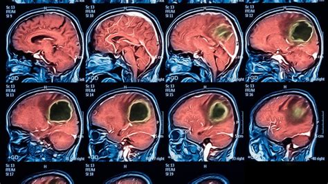 Infografía sobre el algoritmo de tratamiento de abscesos cerebrales en niños