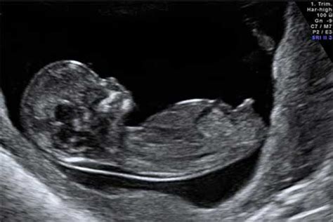 Ejemplo de ecografía 2D del segundo trimestre mostrando la anatomía fetal.