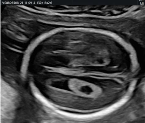 Ecografía fetal mostrando un quiste en el plexo coroideo