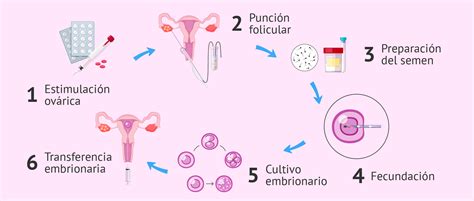 Esquema explicativo del proceso de fecundación in vitro con óvulos de donante y esperma de la pareja o donante.