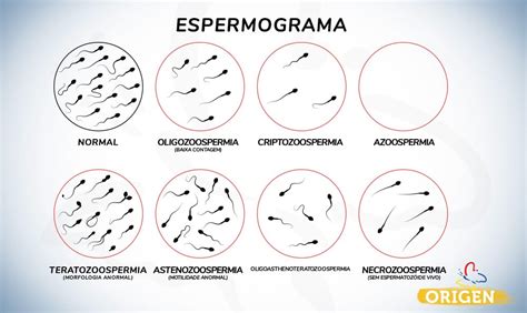 Infografía comparativa: parámetros de un espermiograma normal frente a un espermiograma con alteraciones.