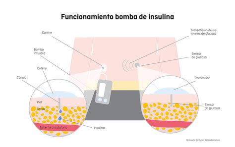 Infografía sobre cómo funciona la bomba de insulina: reservorio, catéter y administración de bolo vs dosis basal.