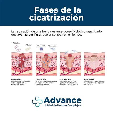 Infografía: Fases de la cicatrización de una herida