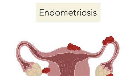 Ilustración anatómica que muestra la endometriosis y la presencia de tejido endometrial fuera del útero.