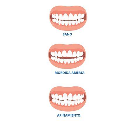Ilustración comparativa: dentición normal frente a mordida abierta por succión