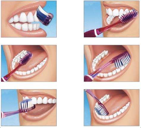 ilustración mostrando la técnica correcta de cepillado dental para la prevención de la gingivitis