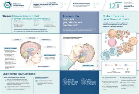 Infografía sobre los tipos de tumores pediátricos más comunes