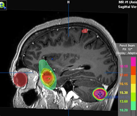 Imágenes de RM mostrando metástasis cerebrales