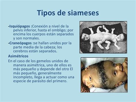 Diagrama de las distintas clasificaciones anatómicas de los siameses (toracópagos, pigópagos, isquiópagos, etc.).