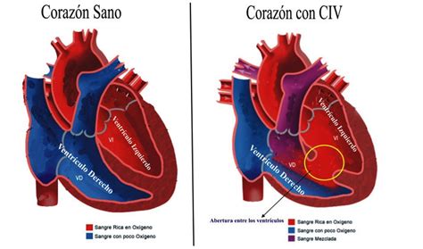 Esquema anatómico comparativo de un corazón neonatal con y sin defectos congénitos (CIV, CIA, ductus arterioso).